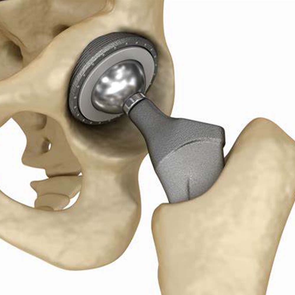 Joint Replacement Surgery