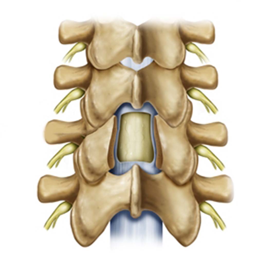 Laminectomy