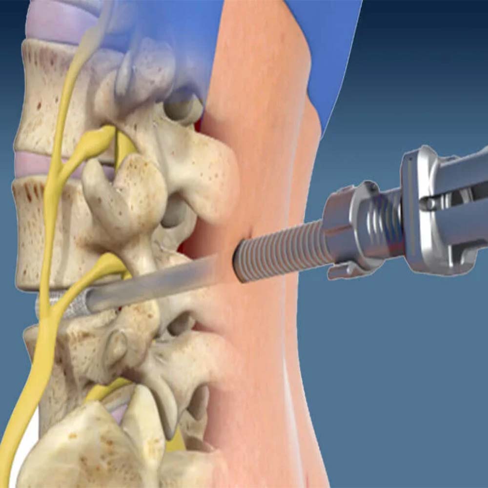 Minimally Invasive Spine Surgery