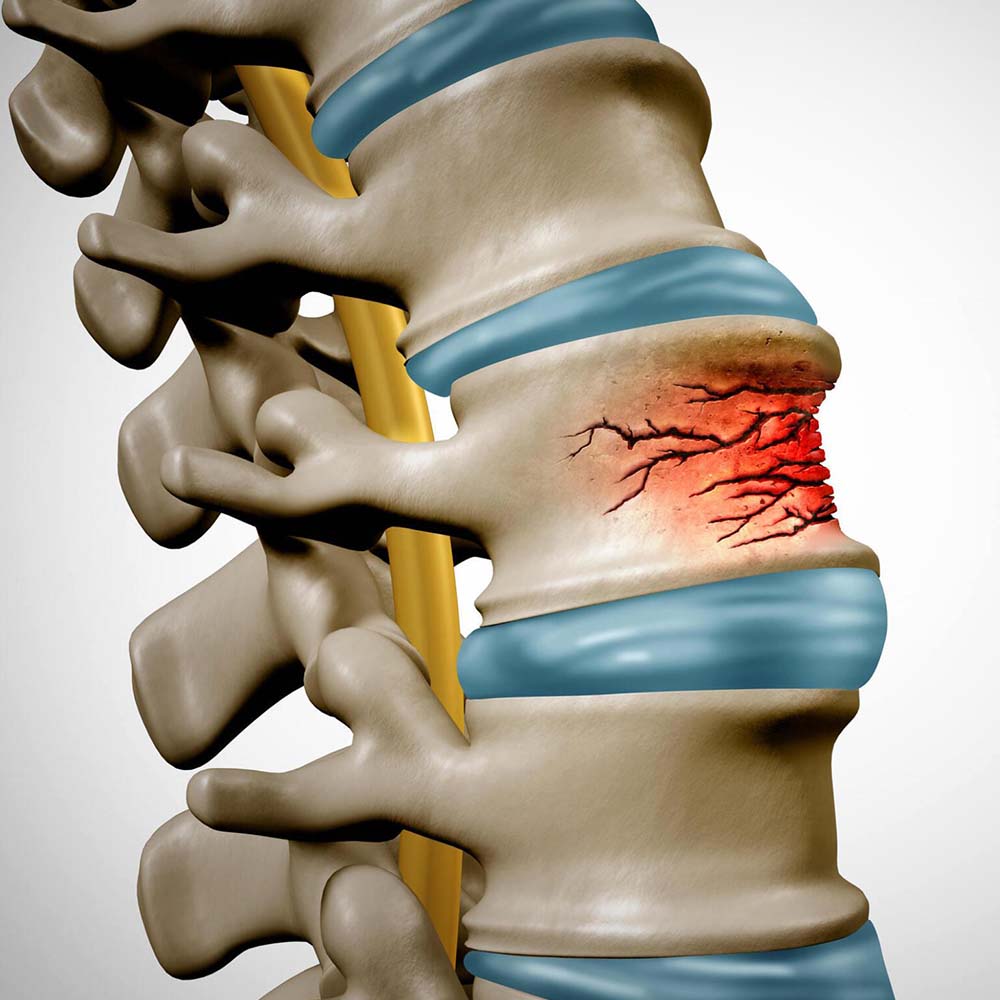 Osteoporosis