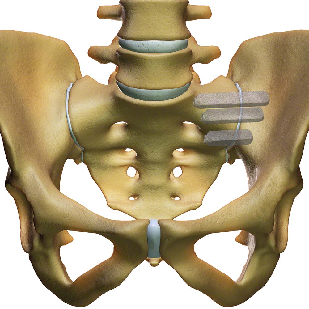 Sacroiliac Joint Fusion