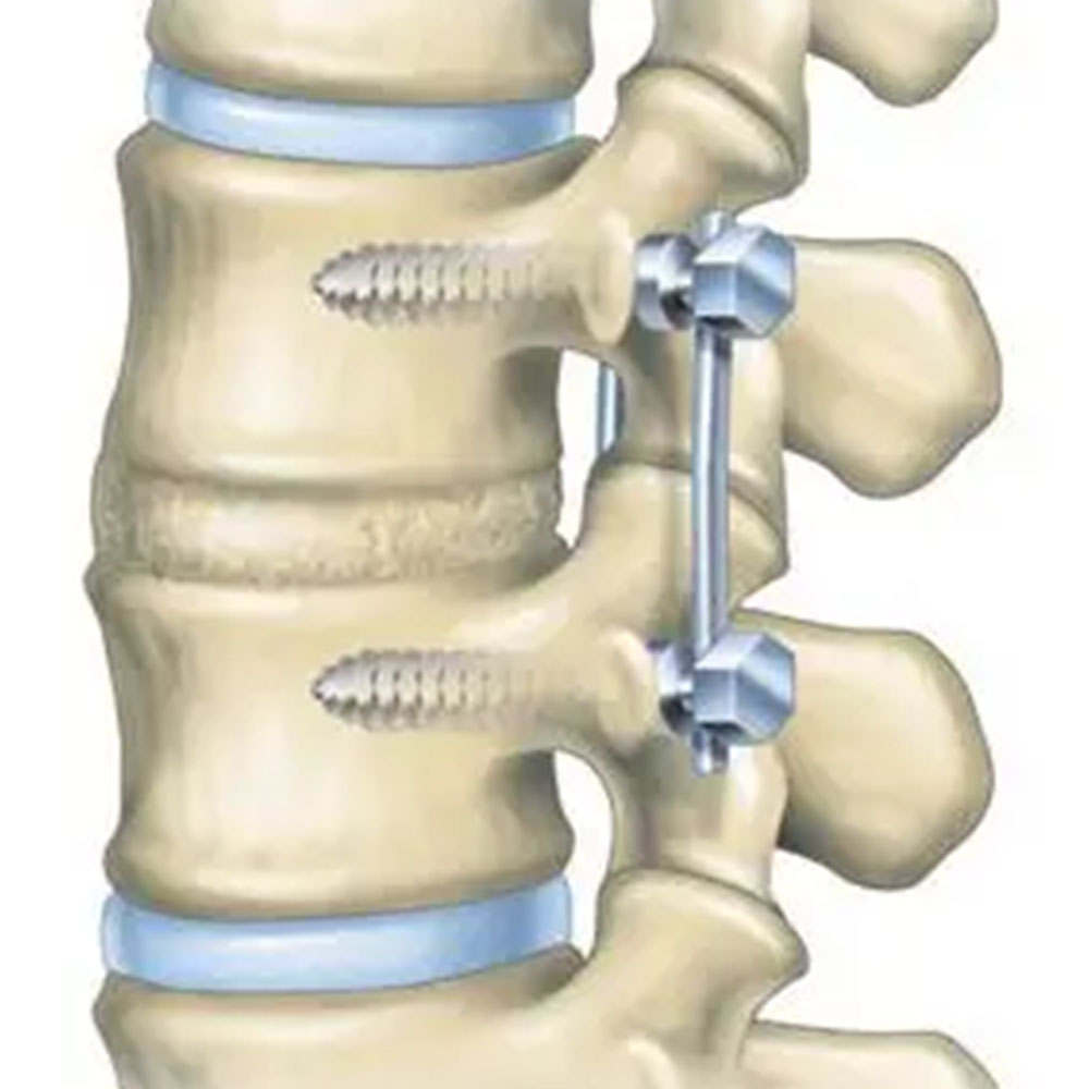 Spinal Fusion